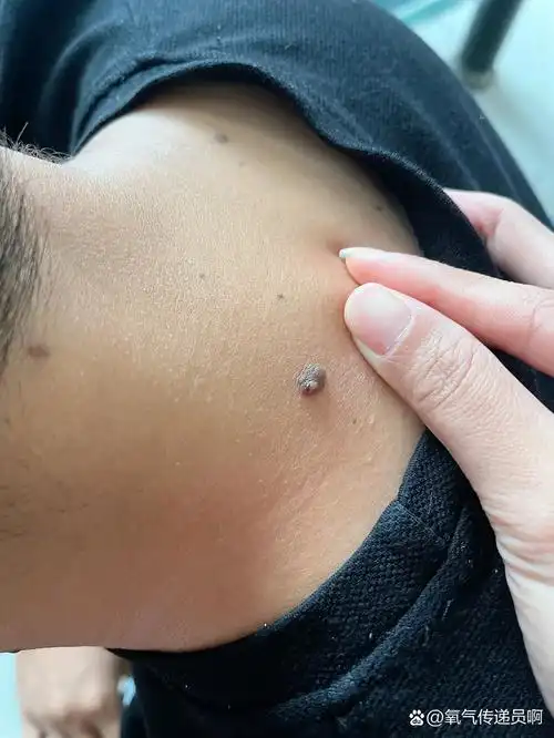 黑痣 老公脖子上长了很久的痣,网友帮忙看一下有什么问题吗