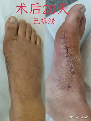 20年底拇外翻截骨矫形手术,术后一个月.