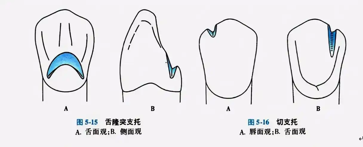 切支托 放置于尖牙或切牙的近中切缘上(图5-16).