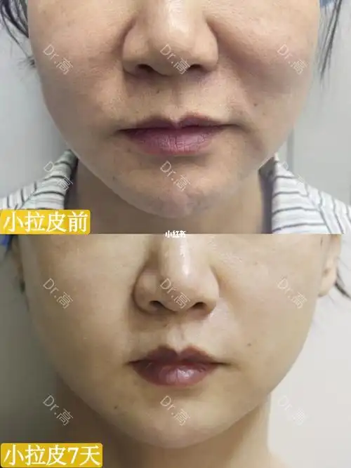 双平面复合小拉皮7天效果_拉皮_法令纹_素颜_相机_苹果肌_拉皮手术_美