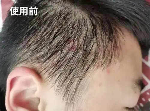 头皮护理新体验璞棠头皮修护精华液精准修护每一寸头皮