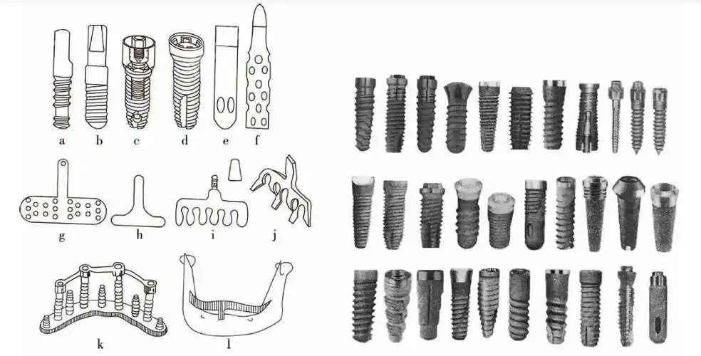 黄冈种植牙多钱做一颗半口满口种植牙价格6000元起真不高