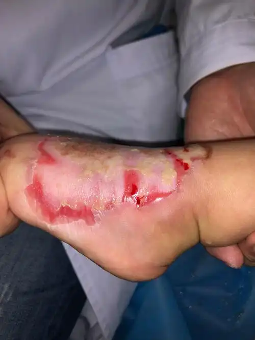 开水烫伤怎么办,一定要懂的紧急处理方法!_大全-幸福起航