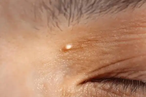 22号眼角的小颗粒不仅会影响美观,还有可能是健康问题!