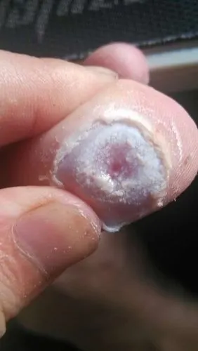 问:我的脚鸡眼这是根治了吗