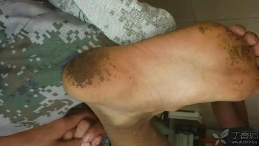 脚底长了很多黑色小坑,求大神解释