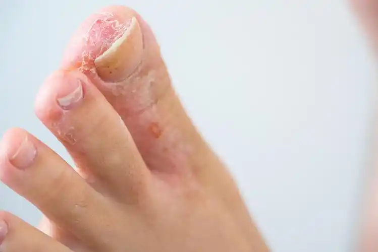 暴雨之后请注意烂脚丫烂裤裆