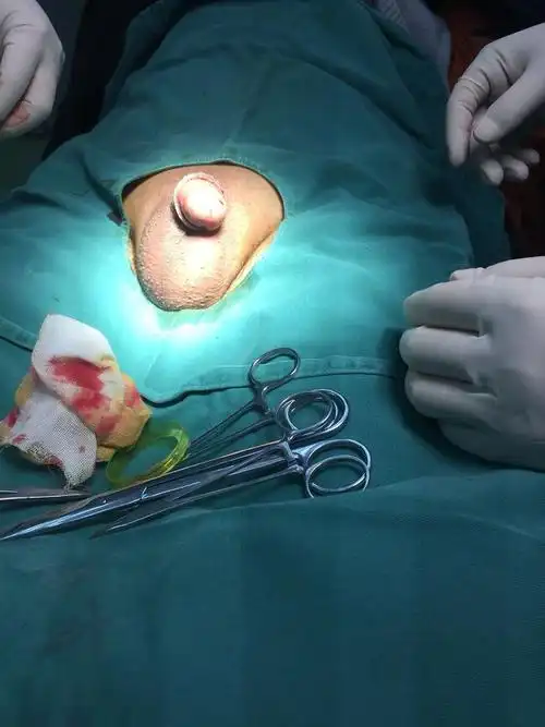 吻合器包皮环切术美观,操作方便,值得推荐,但其费用稍高,且需要取钉子