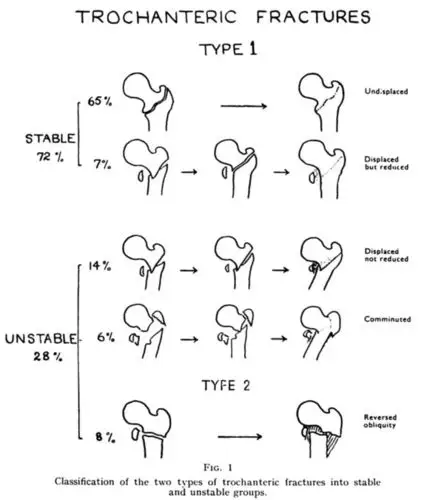 股骨转子间骨折02evans02分型到底应该怎么分