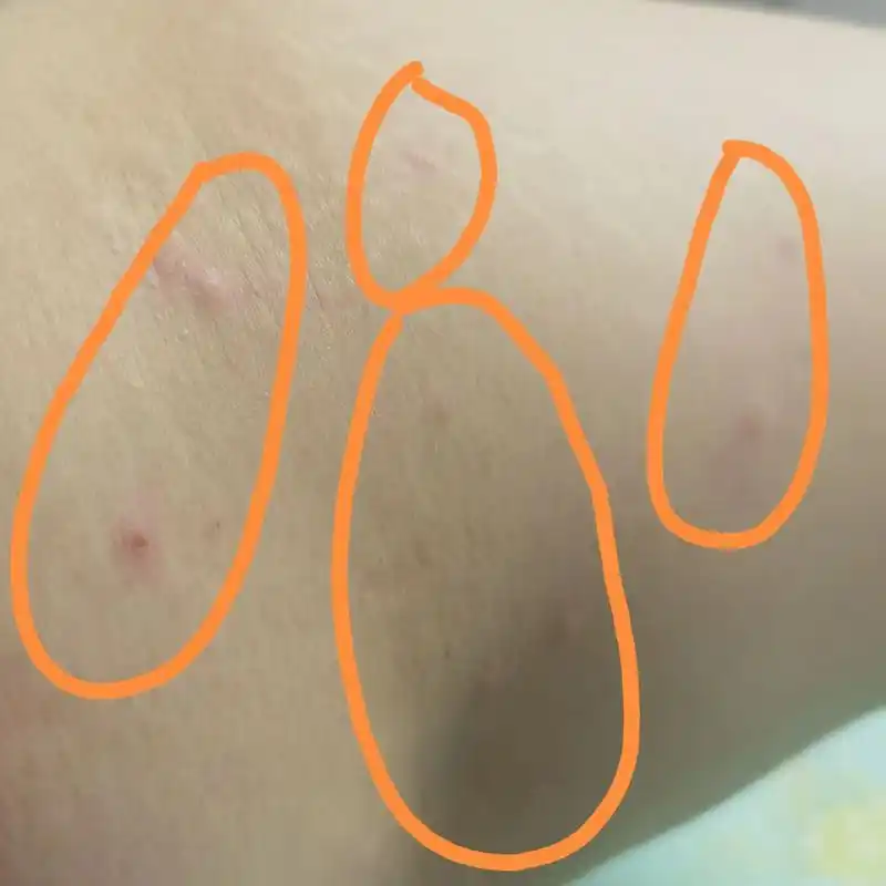 医院说是疥疮,用药四天了.这些疙瘩还是痒的很,特别是晚上痒的 - 抖音