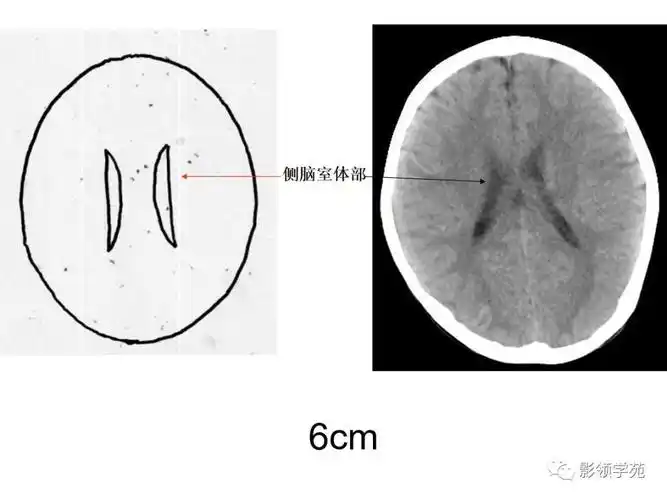 头部ct影像解剖