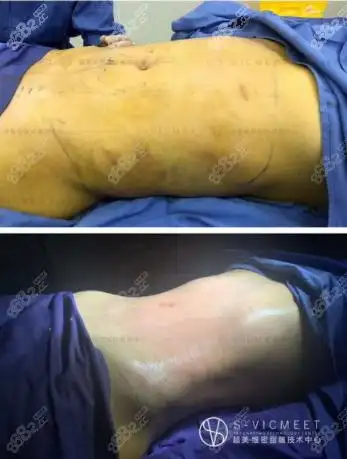 福州维密威塑吸脂修复术挽救你吸脂失败的痛苦,附真人案例