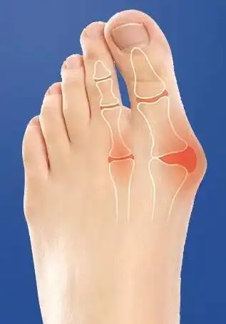 牛江红为您介绍大脚骨/拇外翻基本知识__凤凰网