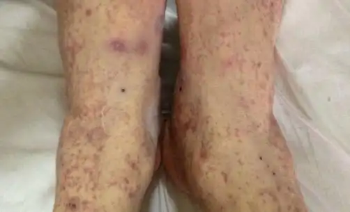 密密麻麻的小红点,过敏性紫癜是皮肤病吗?_症状_孩子