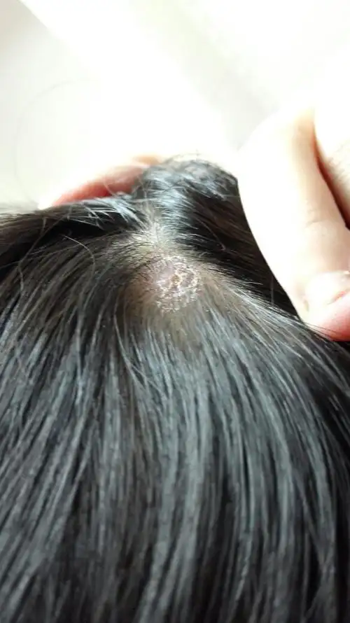 我的头上半个月前长了个包一样的东西,因为不舒服