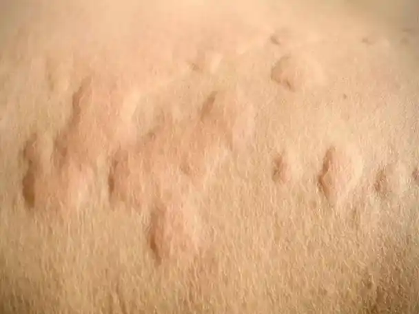 过敏性皮炎的预防和护理