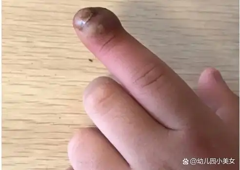 爱啃指甲的孩子会造成严重后果家长引导要有技巧