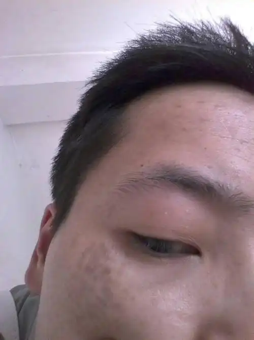 我是男的,今年24岁,眼角长斑,有好几年了,以前没注意,现在一年比一年