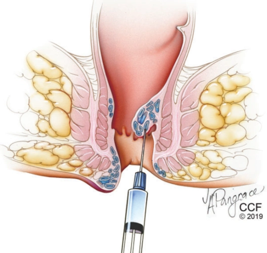 pescatori首先报道采用经肛门吻合器直肠黏膜切除术治疗直肠黏膜脱垂