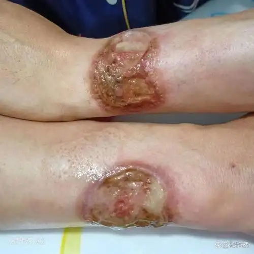 烫伤了该怎么办