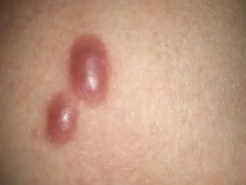 胸口长了两颗小包是什么,三四年了