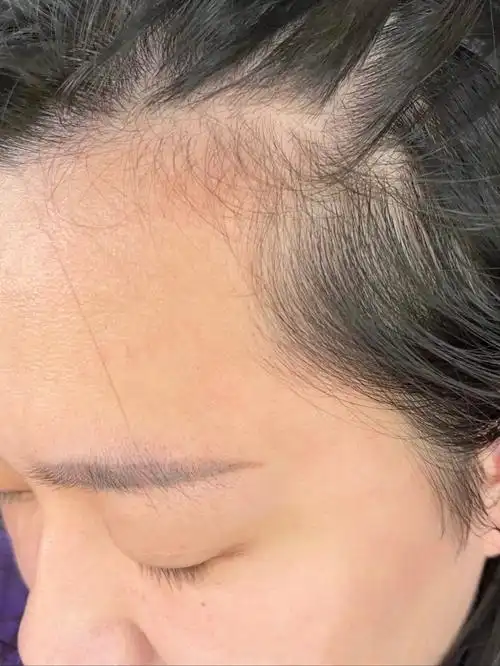 我想问问20多岁发际线这样正常吗