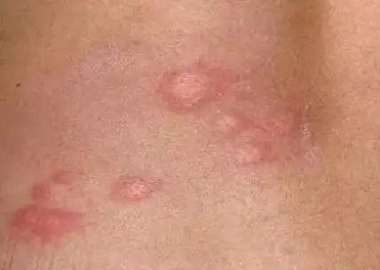 小孩身上出现这几个症状,或说明家里螨虫"成堆",家长别忽略了