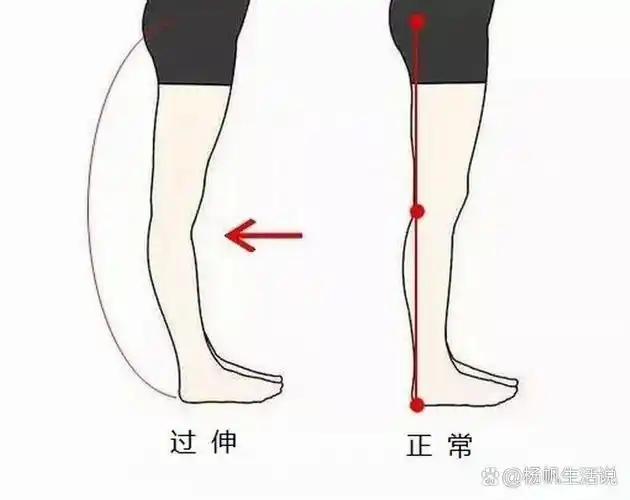 侧面看小腿弯曲,不直,该怎样拥有美丽的双腿 那是因为你存在膝超伸的