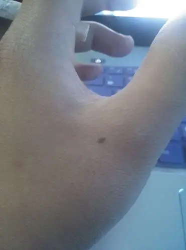 命相:左手虎口有颗痣,从小就有