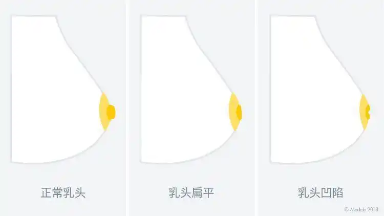 现在怀孕5个月了,可我乳头内陷,要怎么给宝宝喂奶? - 知乎