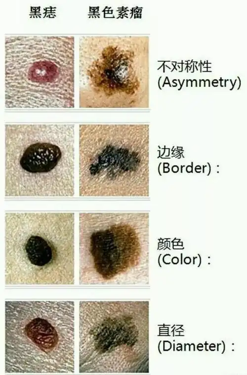 长这样的痣,可能会引起癌症!