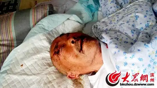 博兴县庞家镇高庙李村李学会老人眼睛,耳朵内长满蛆虫
