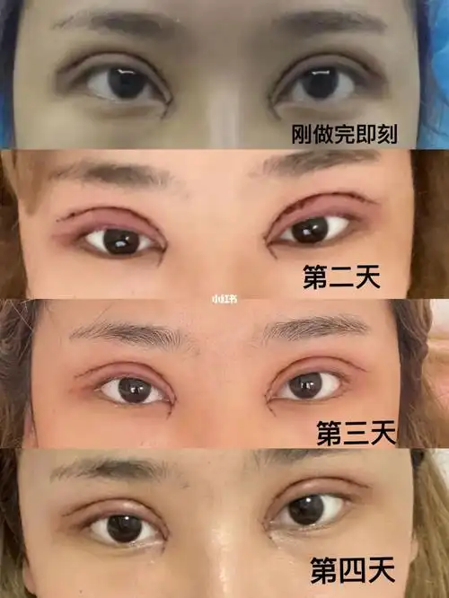 全切双眼皮77开内眼角_双眼皮手术_全切双眼皮_内眼角_全切双眼皮