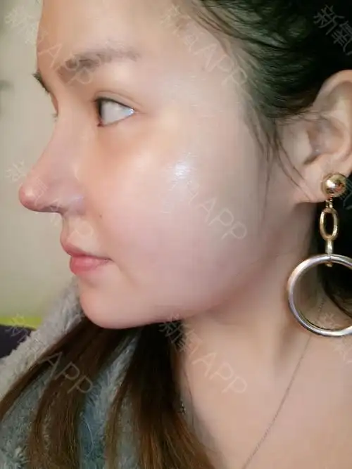 做了鼻子一个多月了,鼻子又高又细又假,和自己的脸十分不协调,可以