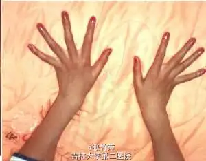 四肢细长,蜘蛛指,双臂平伸指距大于身长,双手下垂过膝,下半身比上半身