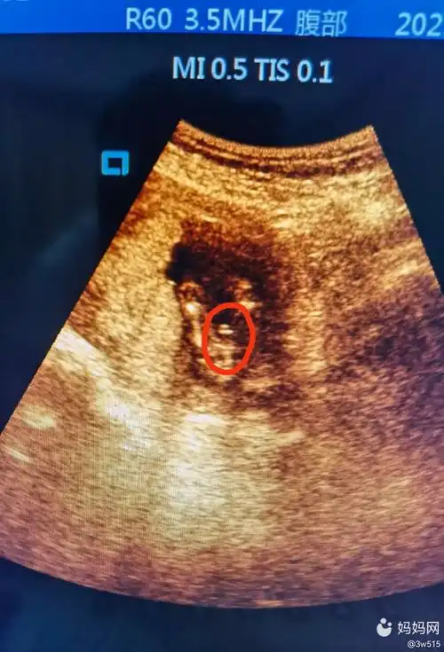 孕18周 5天中山市8月31日              2                       6