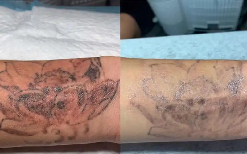 洗纹身不留疤,济南小哥手腕纹身清洗真实案例对比