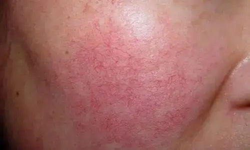 红血丝和敏感肌到底是不是一回事?