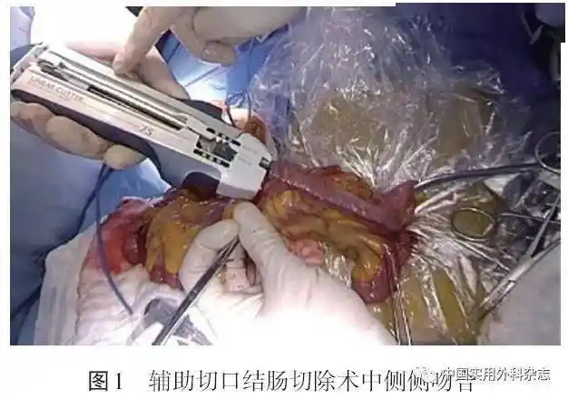 专家共识腹腔镜结直肠外科手术缝合技术与缝合材料选择中国专家共识