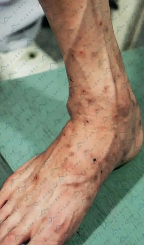 艾滋病人100会出现的皮肤症状表现详解