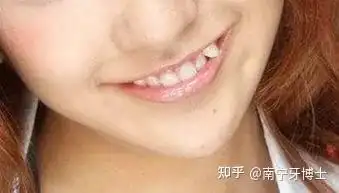 小虎牙的"可爱"与"可恨"——原来它是这样诞生的? - 知乎