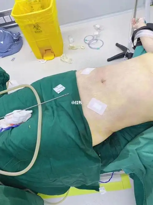 腰腹环吸_腰腹_减肥_减肥医药