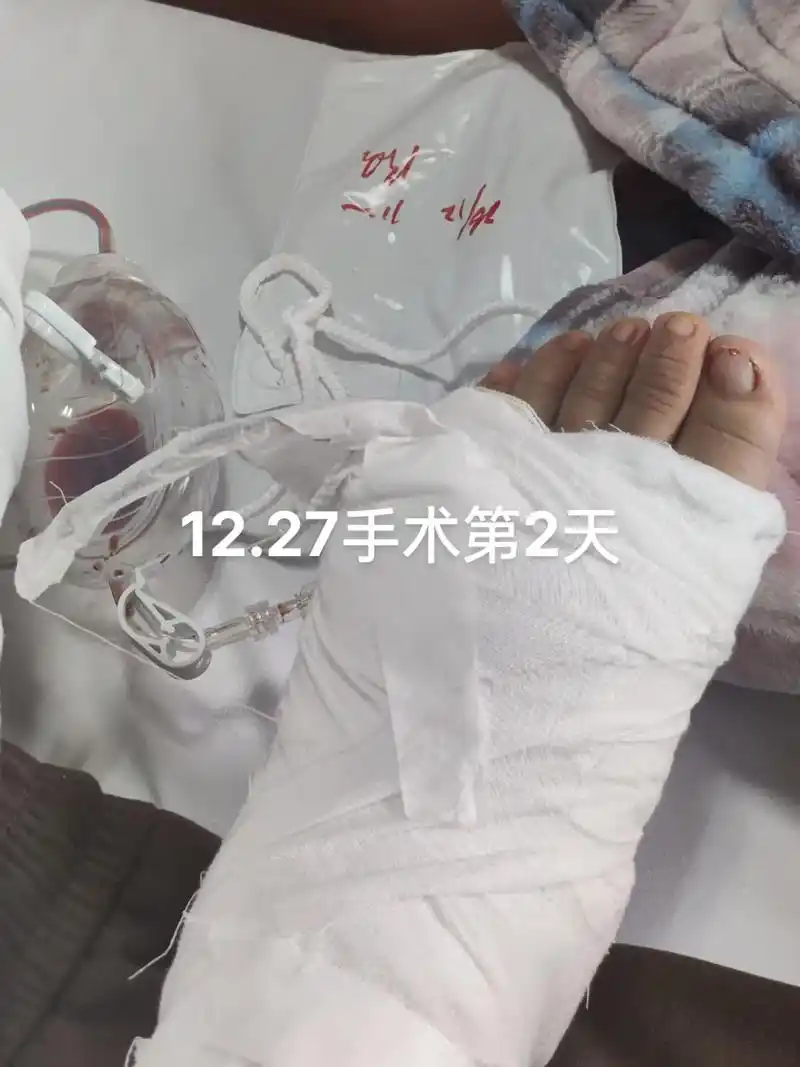 今天去拆了左边两颗钉子,不打麻药,生拔!拔之前,医生说我,又 - 抖音