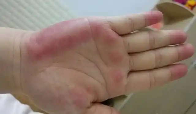 十指连心,手掌颜色看健康,如果颜色变这样,不是大病就是癌!