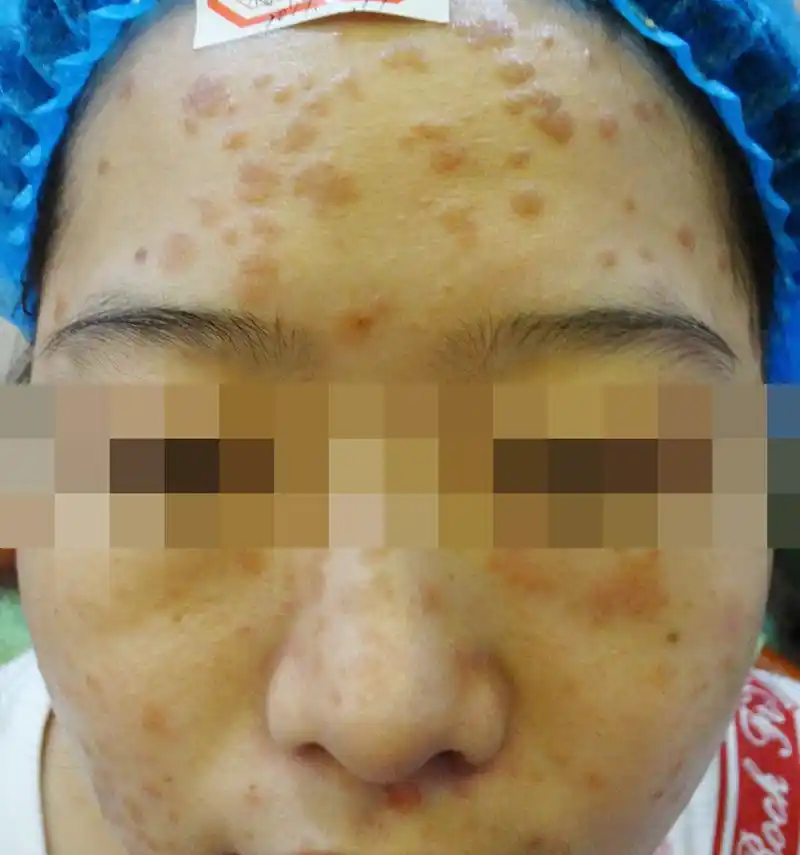 扁平疣是种什么病,传染吗,怎么治疗?