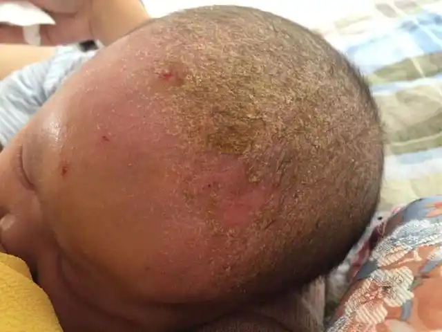 想不知道怎么办了!湿疹头上结黄痂,孩子用手擦破皮了,真头疼