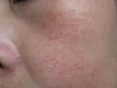 红血丝形成原因具体是什么