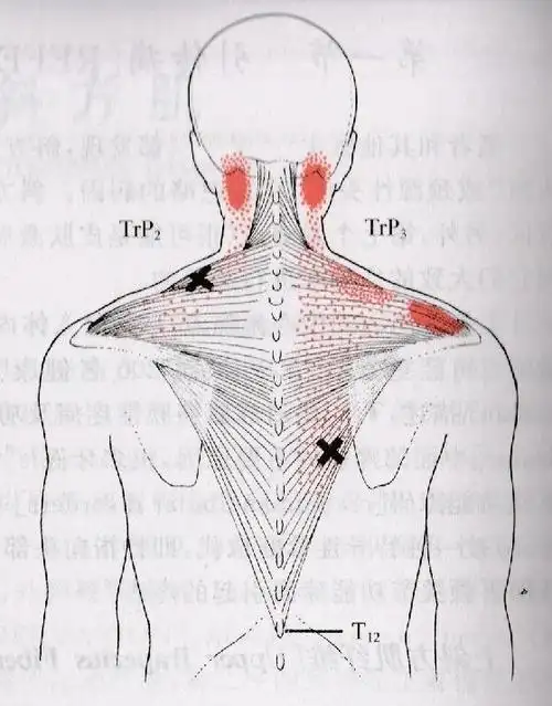 中医适宜技术--肩背部软组织损伤的治疗方法与策略 1|斜方肌|枕骨|棘