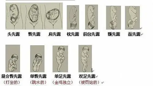 什么是胎方位示意图_有来医生