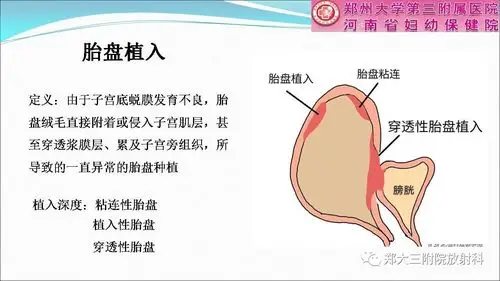 胎盘植入的介入治疗